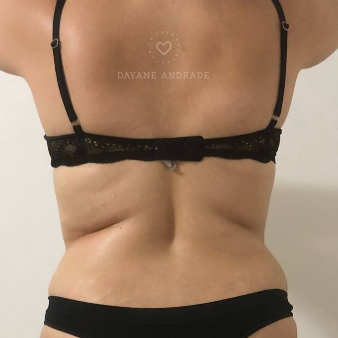 Back and flanks, after treatment