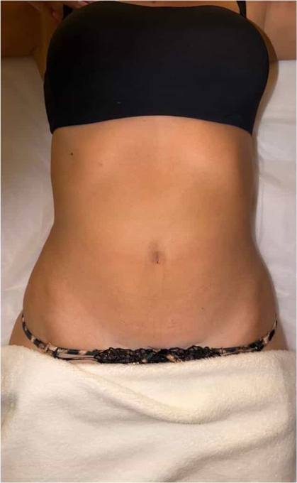 Abdomen, before treatment