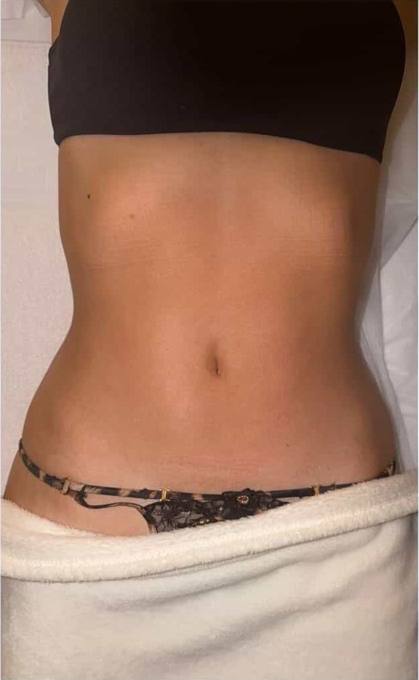 Abdomen, after treatment