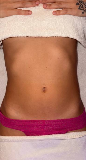 Abdomen, before treatment
