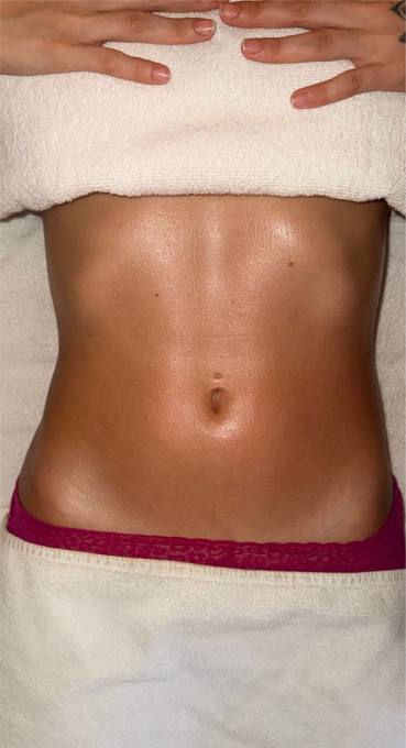 Abdomen, after treatment