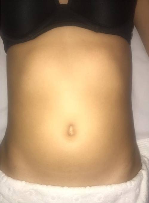 Abdomen, before treatment