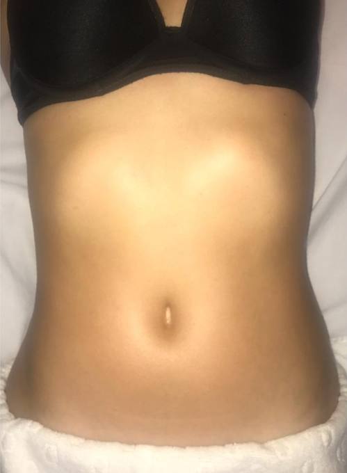 Abdomen, after treatment