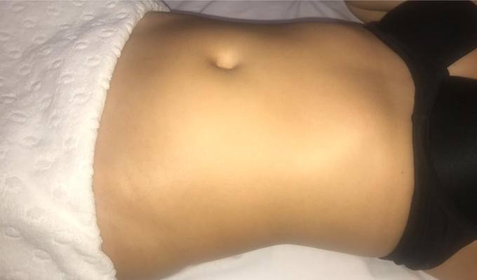 Abdomen, before treatment