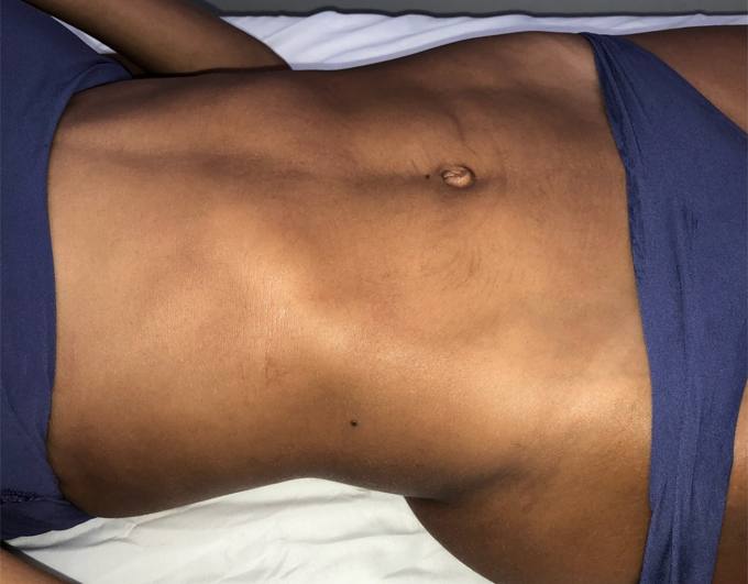 Abdomen and waist, before treatment