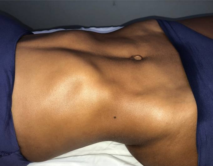 Abdomen and waist, after treatment