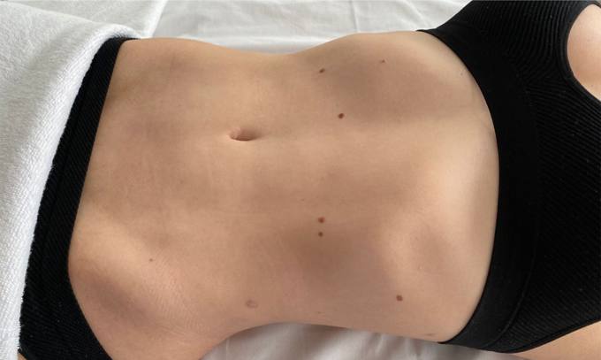 Waist and contour, before treatment