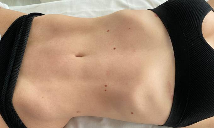 Waist and contour, after treatment